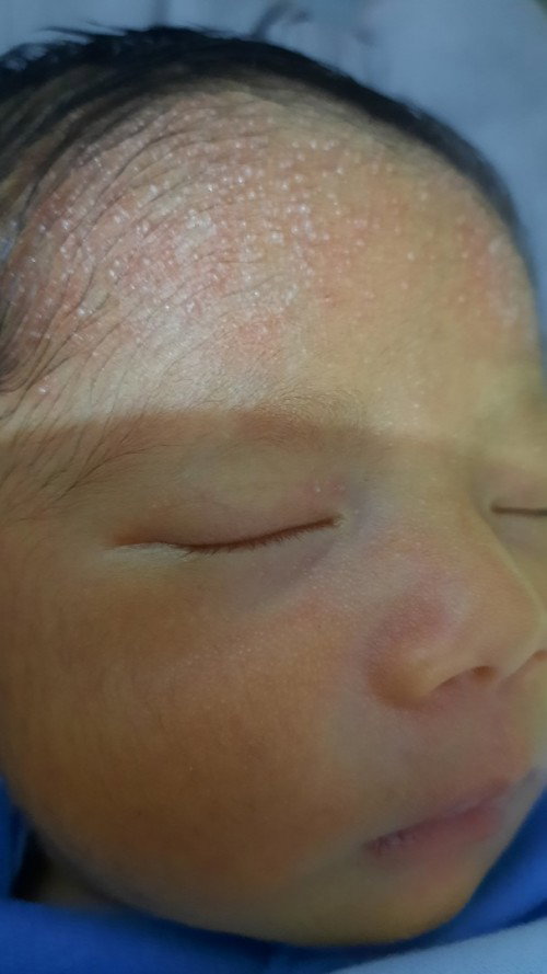 Jidat Bayi Bruntusan