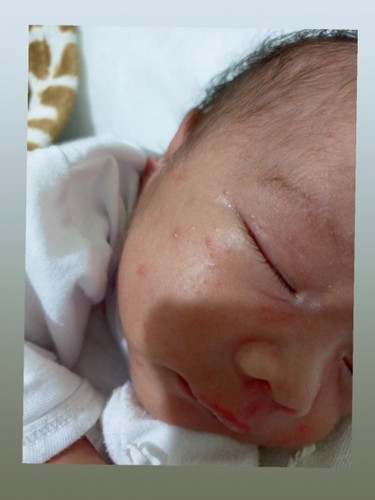 Baby rashes on face