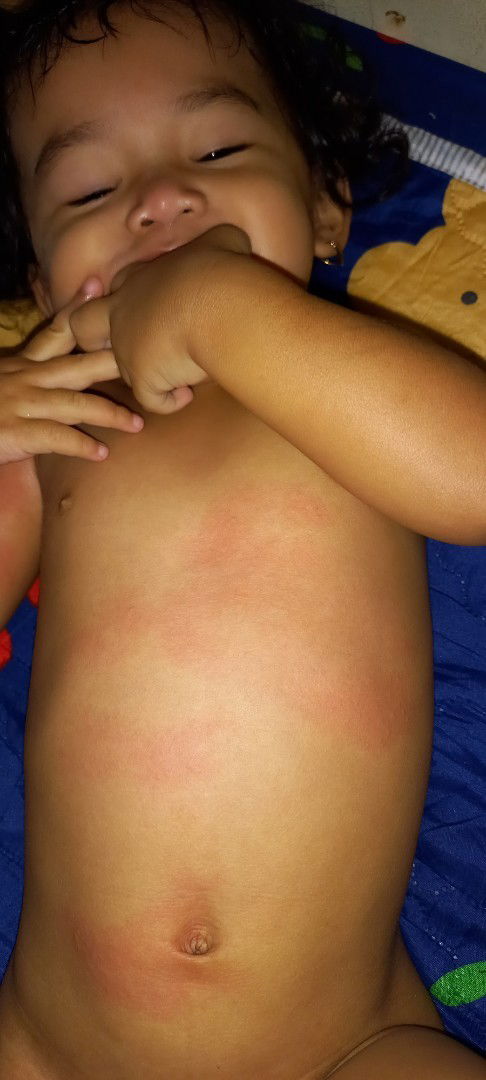 Bercak merah dan bentol kecil