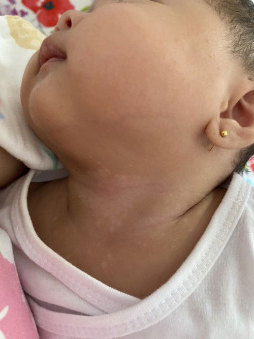 Ano po kaya itong nasa leeg ng anak ko parang puti puti po. Salamat po sa sasagot.