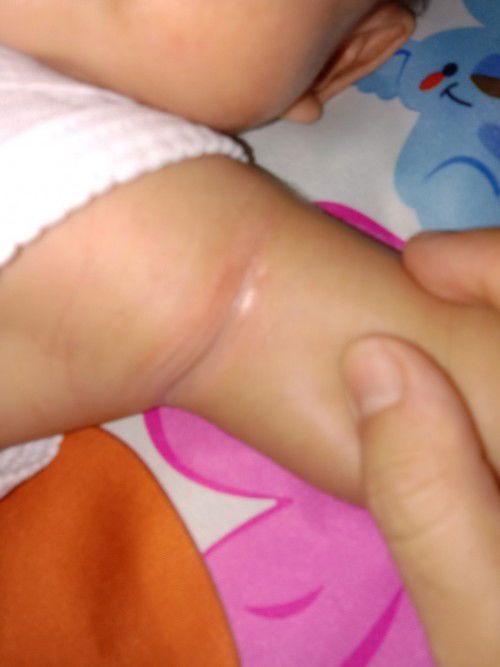 Lecet/kemerahan diketiak