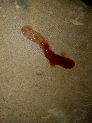 Keluar darah ngegumpal saat hamil