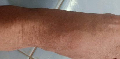 ผื่นแดงตามตัว ท้อง35สัปดาห์