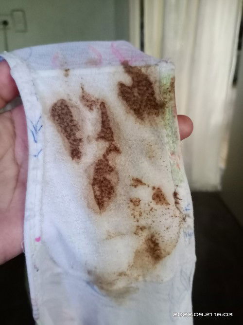 Brown discharge after IE