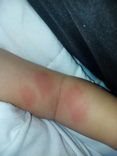 Insect bites po ba ito?