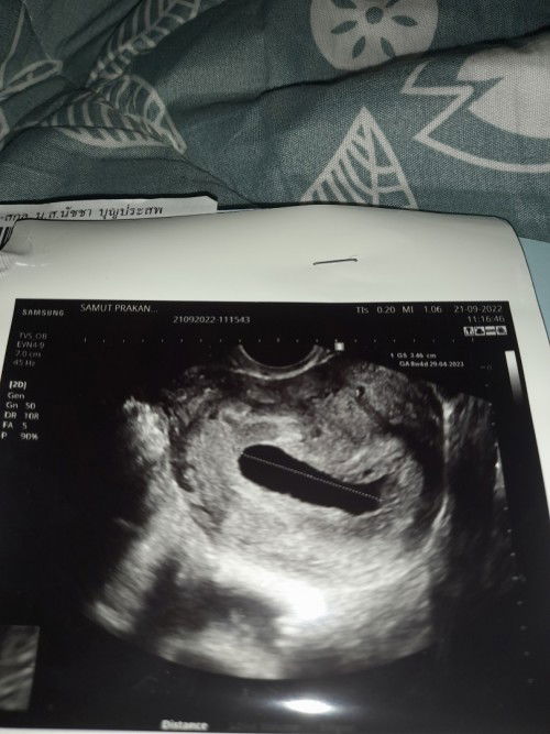กังวลมาก 10w ไปซาวด์มาแล้วเจอแต่ถุงการตั้งครรภ์