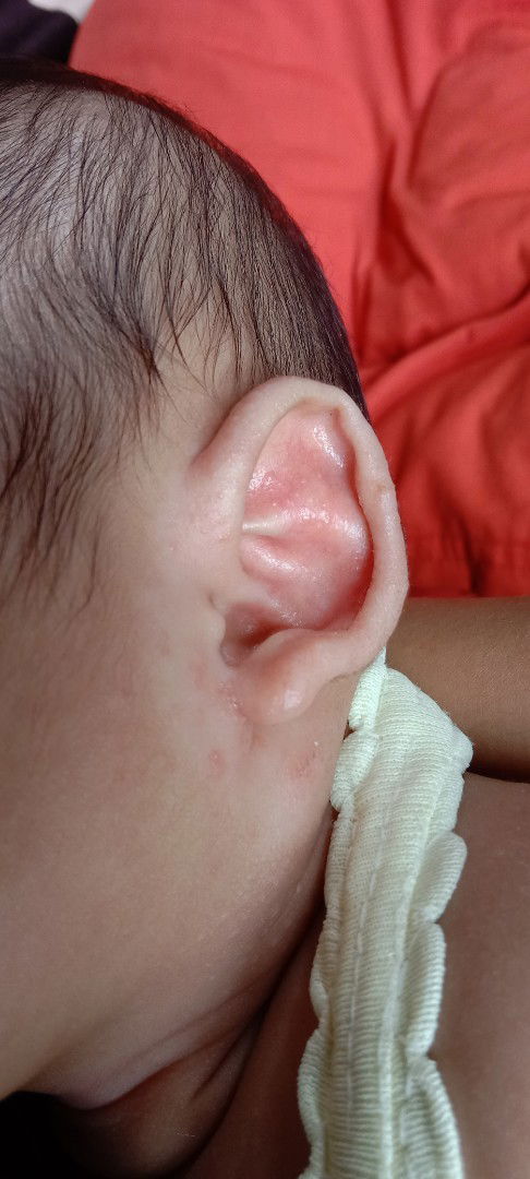 Ada yg tau ga bun apa ya penyebab telinga bayi kaya gini? Kemarian sudah hilang terus timbul lagi