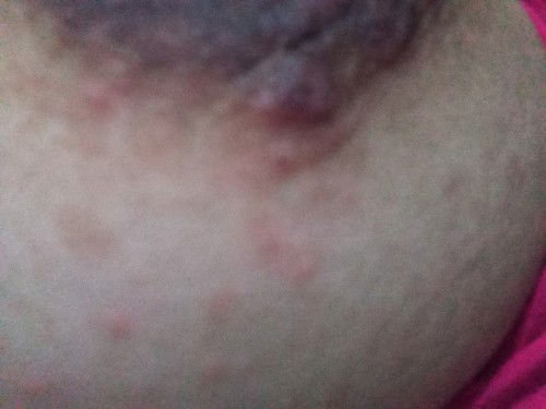 Butlig sa boong katawan