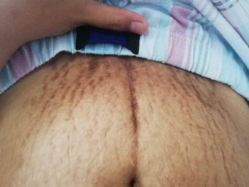 stretch marks