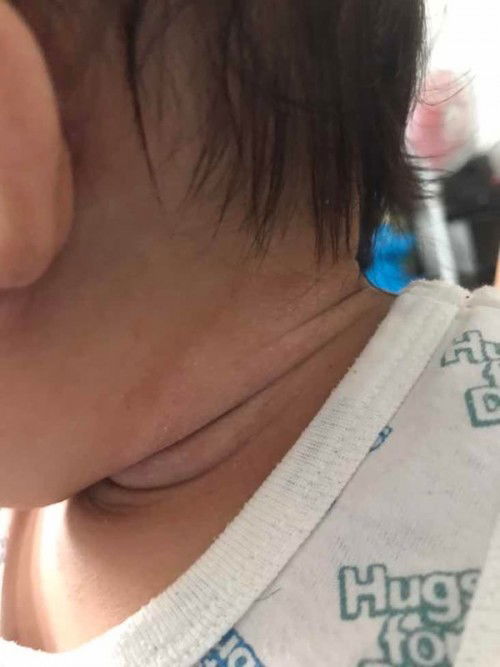 Neck rash-need advice