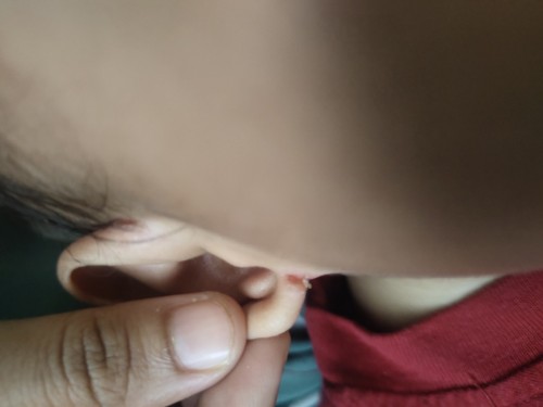Rekomasi obat untuk telinga bayi yang lecet