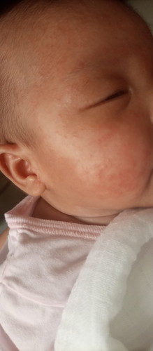 Baby acne/rashes