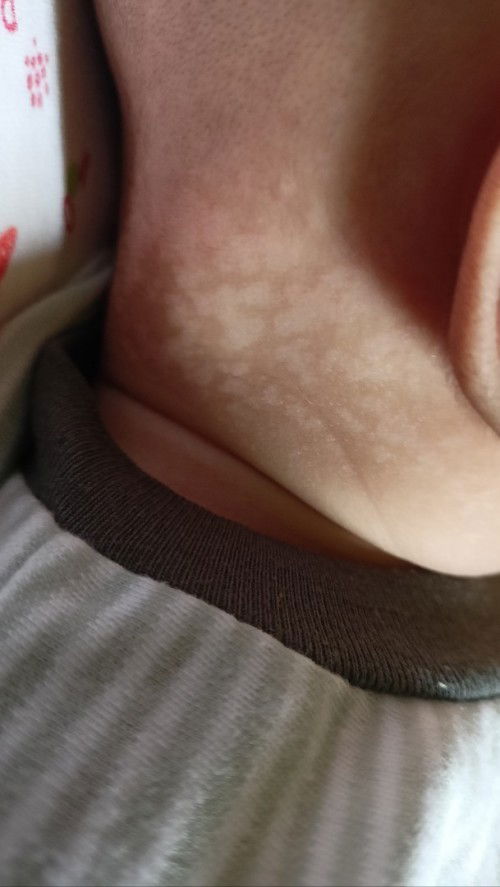 Bercak dileher dan punggung bayi 3 bulan