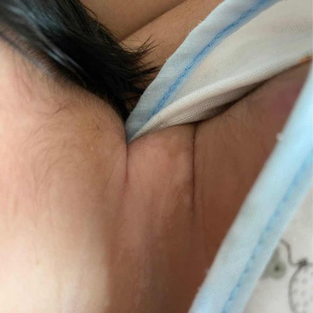 น้องเป็นผื่นที่คอแบบนี้ทั้ง 2 ข้างเลยคะ