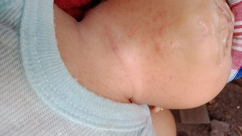 Biang keringat atau alergi ya ?