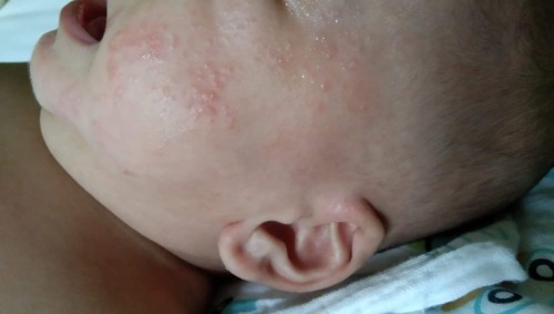ลูก4เดือนเป็นผื่นที่หน้า