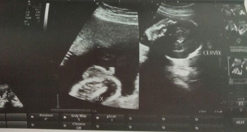 Hello po normal po ba yung ultrasound ko and confirm na po kaya na baby boy si baby ? 😊