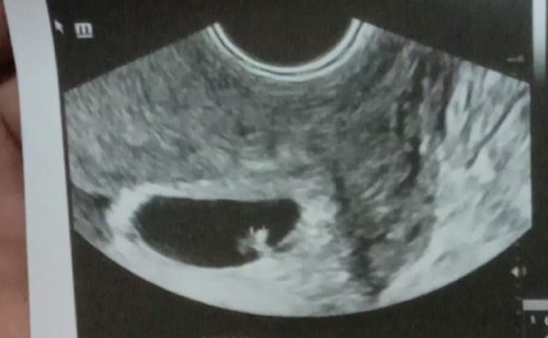 Second baby 6weeks preggy and has 1yr old and 1month