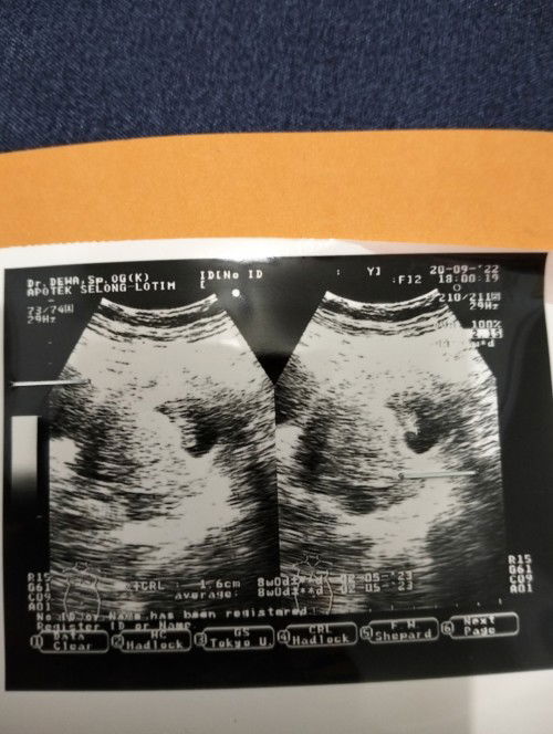 hamil ada kista , tapi di usg ulang tidak ada