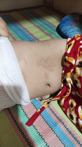 Red patches pls answer...