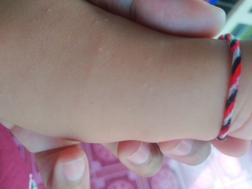 Mau tanya bruntusan seperti ini apa keringat Buntet atau alergi ya karena hampir di sekujur tubuh ?