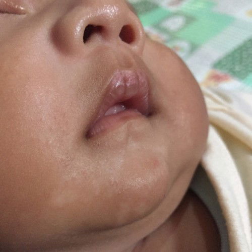 Mengenai bercak putih diwajah?