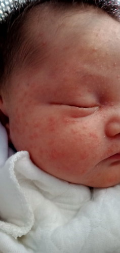 Mga mamshie ask ko lng po anu po ba dapat gawin 2weeks na baby ko .tpos ang daming natubo sa mukha