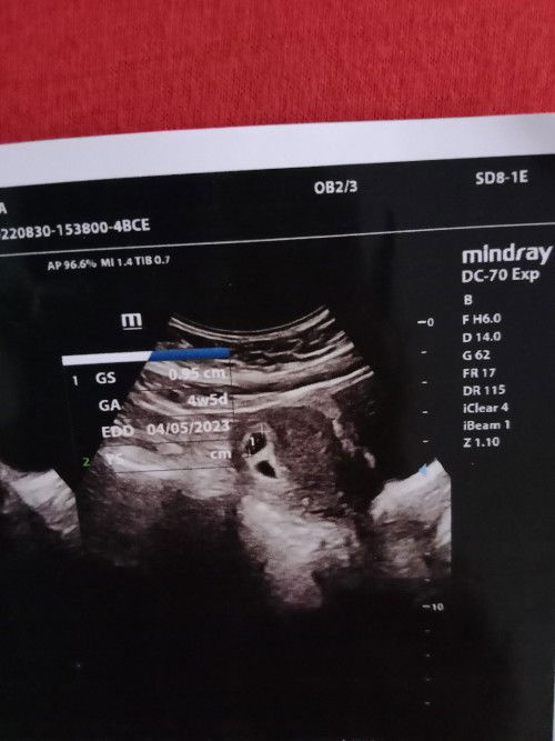 Hasil USG 5 minggu
