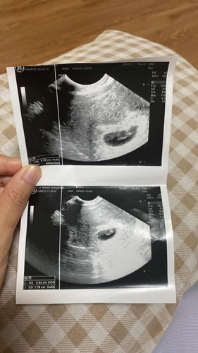 6w6d อัลตร้าซาวด์ทางช่องคลอด