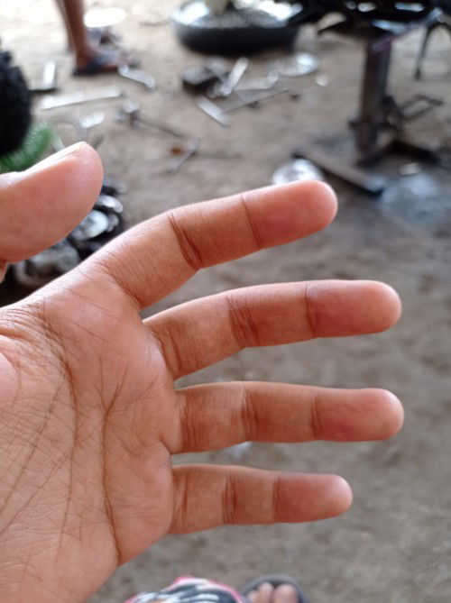 Jari tangan masih kesemutan setelah melahirkan.