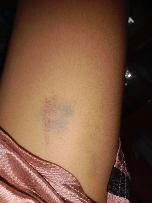 ขอสอบถามแม่ๆหน่อยค่ะมีใครเคยช้ำไม่ทราบสาเหตุตอนท้องไหมค่ะพอดีตอนตรวจเลือดหมอบอกเลือดเข้มข้น