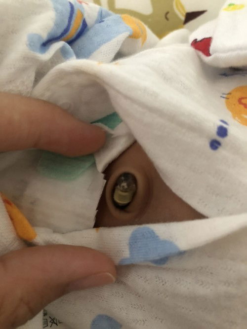 ลูกสะดือเหม็น หลังคลอดได้ 9 วัน