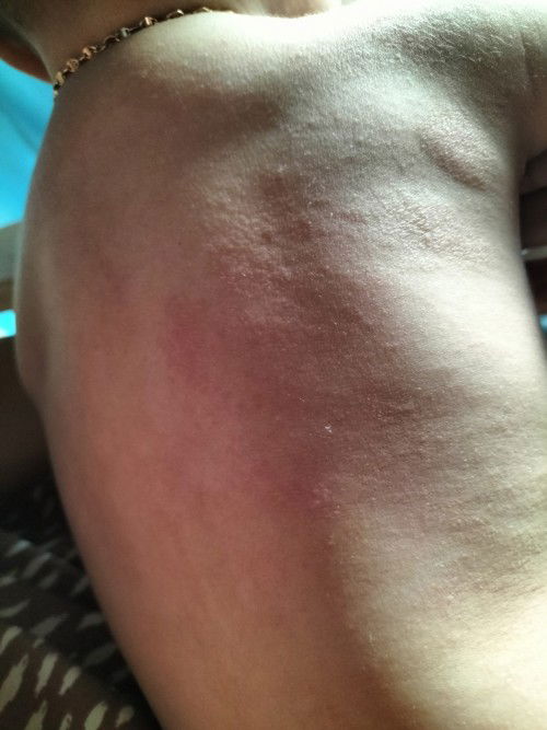 bintik merah di sekujur tubuh anak saya