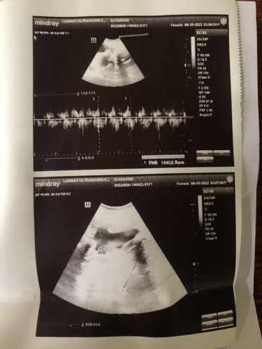 Baby Gender