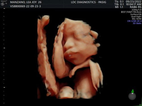 25 weeks and 6 days 3D ultrasound