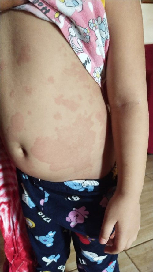 #need answer po, red patches