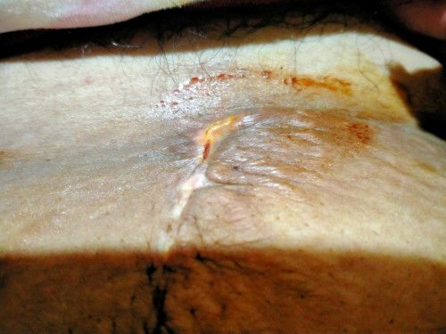 Cs po ako bumuka po un tahi ko sa baba tas nag nanana po sya anu kaya pdeng igamot. 😢