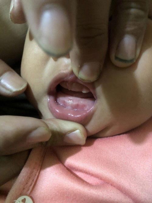 ฟันลูกขึ้นแบบนี้ปกติไหมคะ