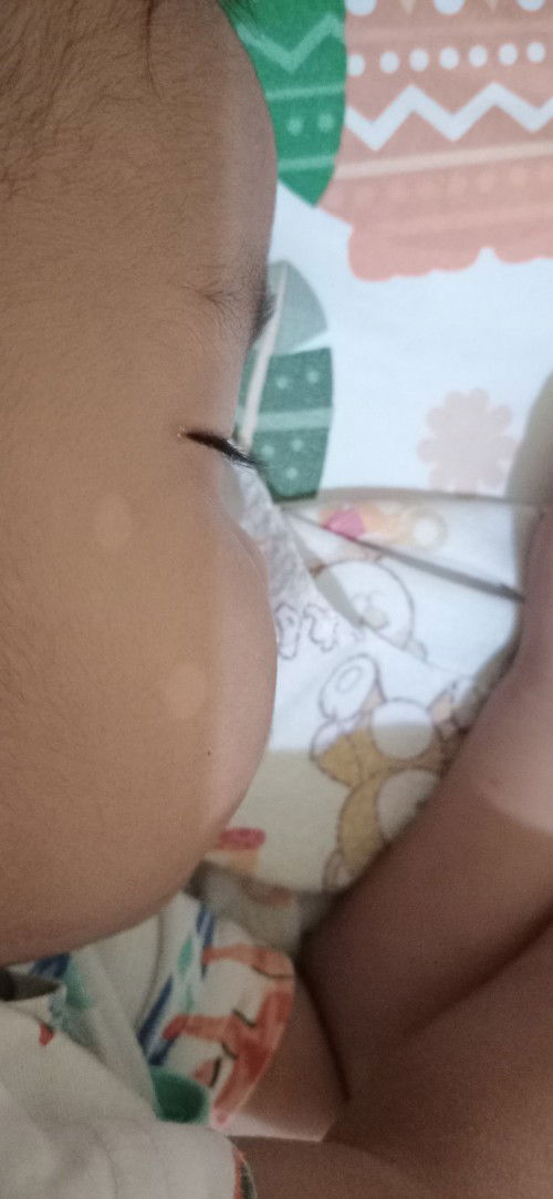 bercak putih di wajah anak 1th
