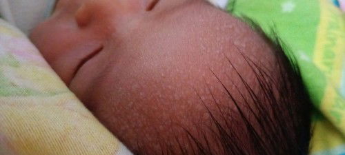 Bintik putih di jidat