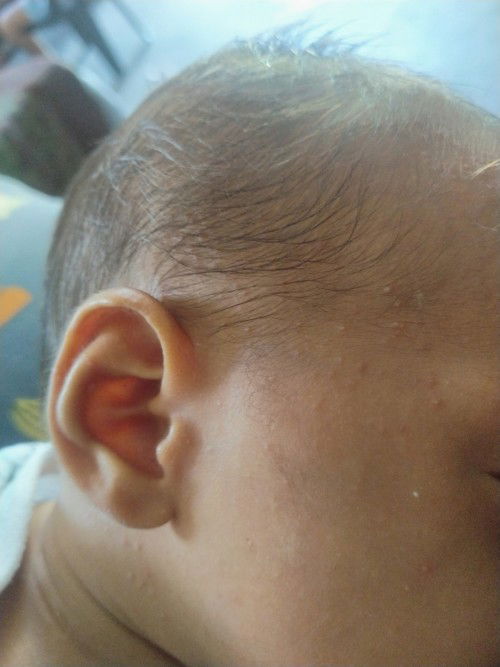 Rashes sa face ni baby