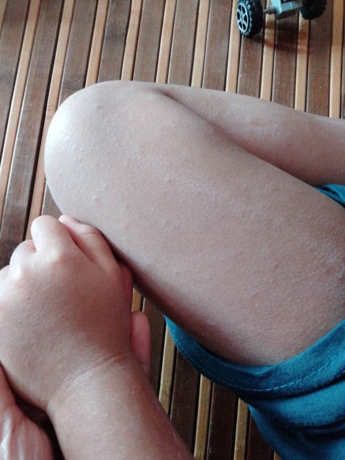 Demam campak selepas hfmd?