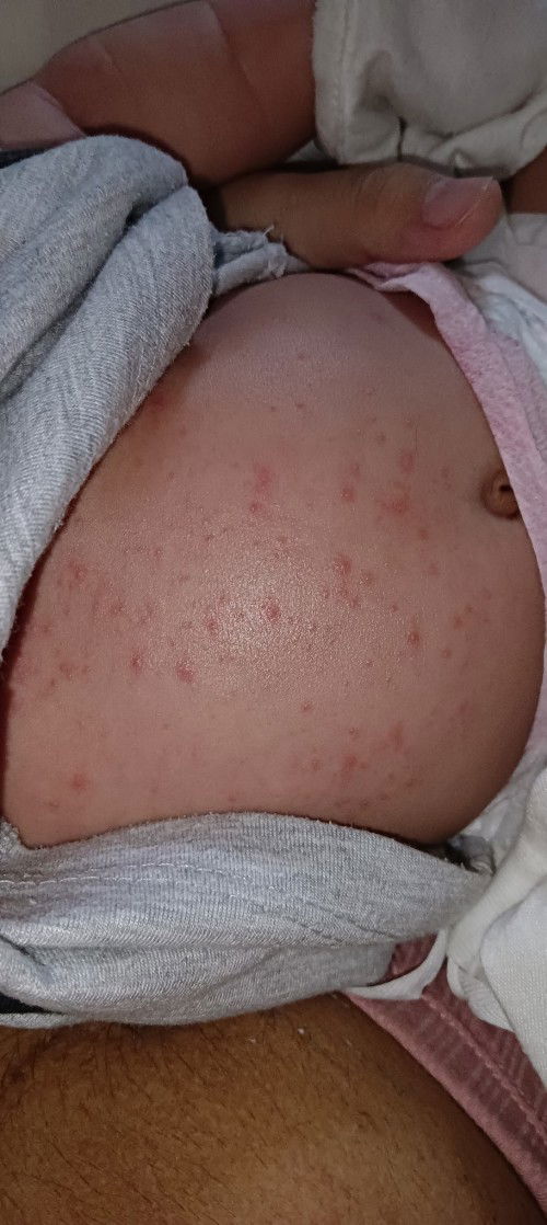 NEWBORN RASHES?