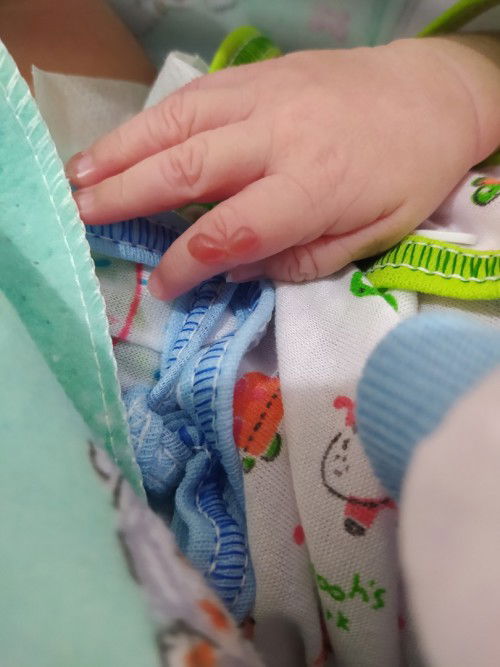 Benjolan air dari bawahan lahir?