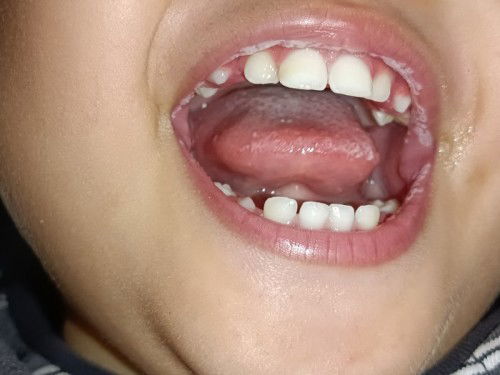 Bibir anak bercak putih putih