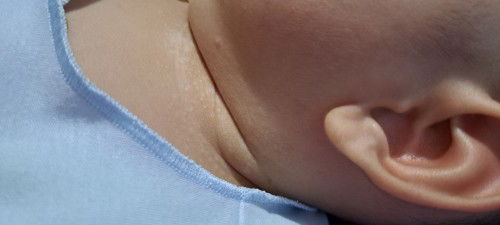 Halo bunda² mau tanya, kenapa kulit leher anak ku seperti ini ya? Ada yg sama kah? Solusinya apa ya?