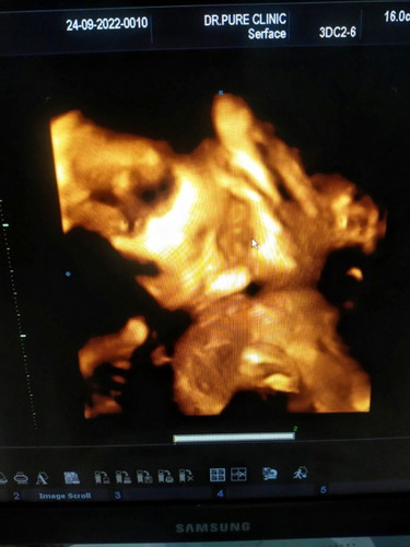 25+6 สัปดาห์ 900 กรัม