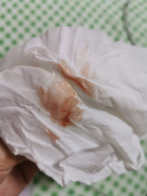 สะดุดแต่ไม่ล้ม มีเลือดออก