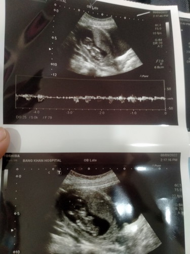 การตั้งครรภ์