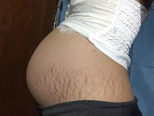 รอยเเตกลาย